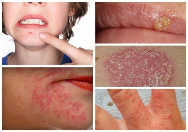 Allergies and skin diseases are symptoms of parasites in the body