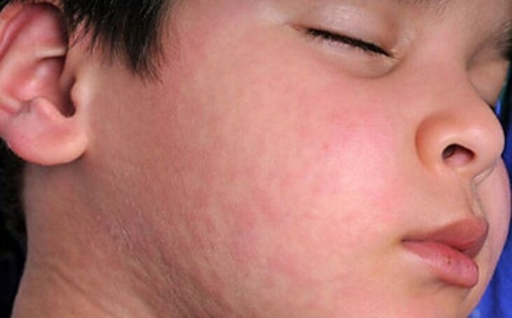 Allergic skin rashes are a sign of parasitic worms in the body