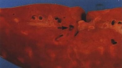 What parasite can live in the human liver
